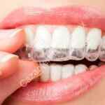 Guarda Dental antiestrés y Limpieza ultrasónica a $199 con Cuponatic (95% de descuento)